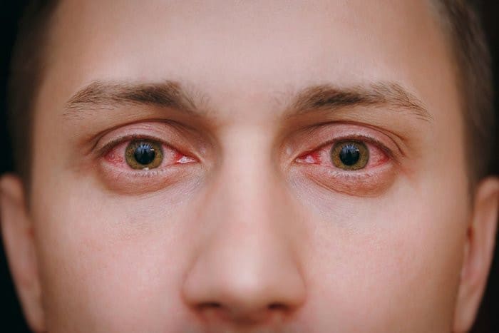 red eyes from smoking weed